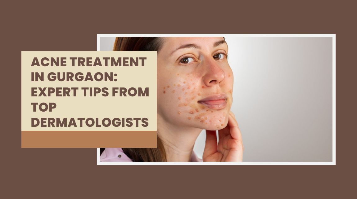 Acne Treatment in Gurgaon
