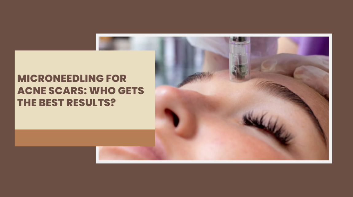 microneedling for acne scars